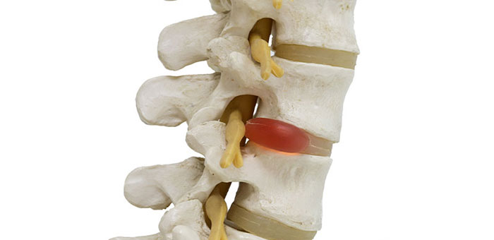 Herniated disc in spine before visiting Akron chiropractor