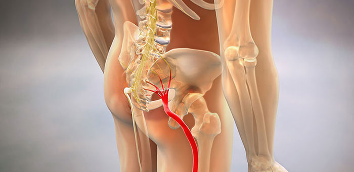 Sciatic nerve pain before chiropractic treatment from Akron chiropractor